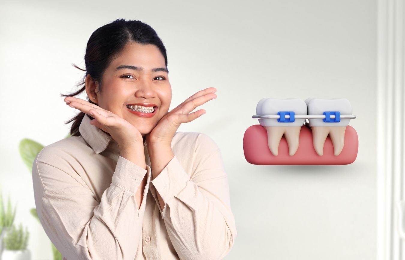 Self Ligating Braces In Nayapalli
