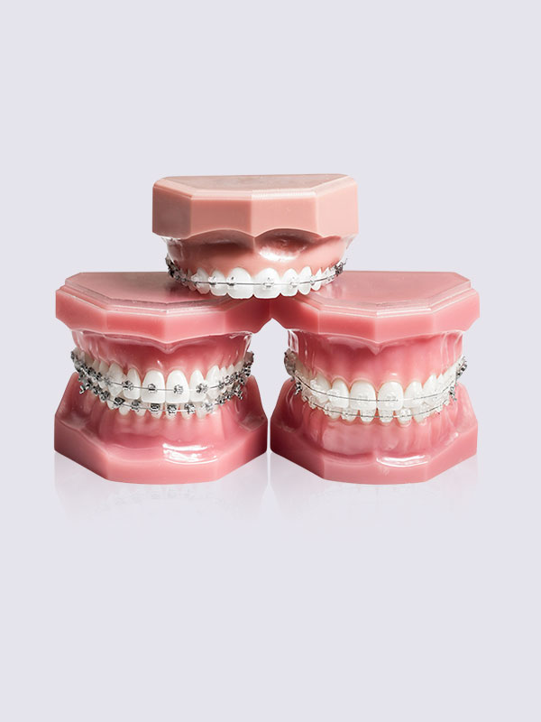 braces-treatment