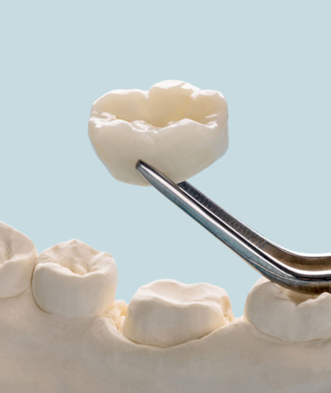 Dental-Crowns