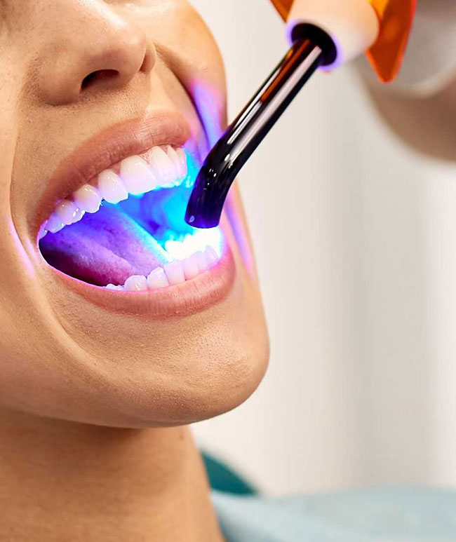 Dental-Filling