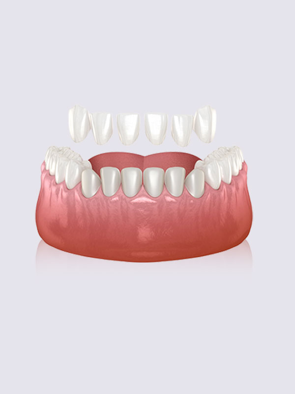 dental-veneers