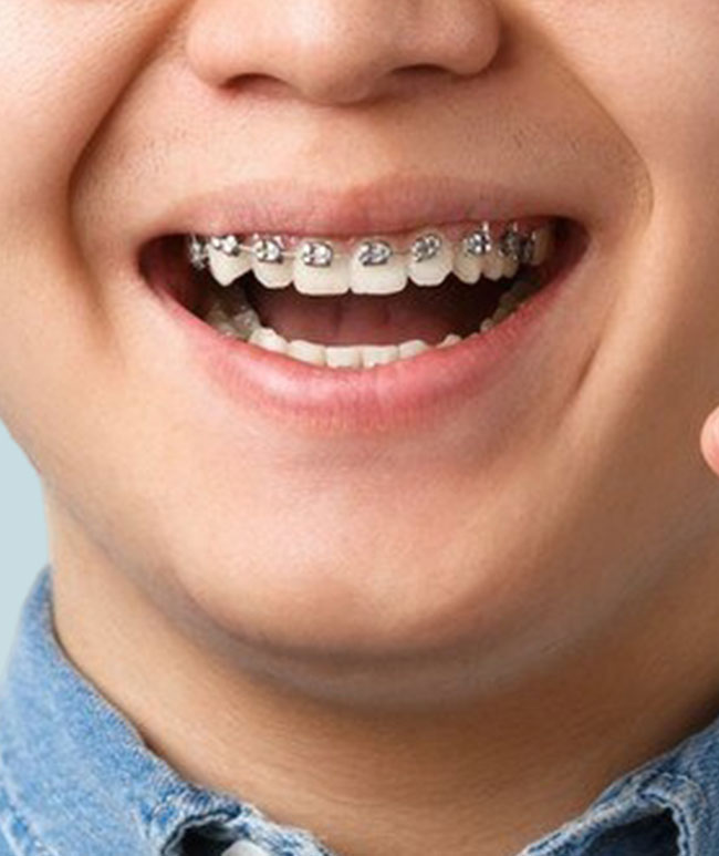 Preventive-Orthodontics-For-Kids