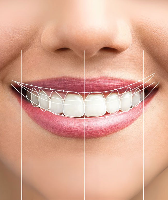 Smile Makeover