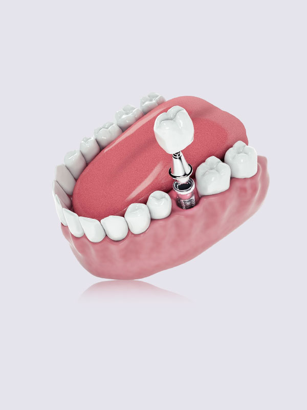 dental-implants
