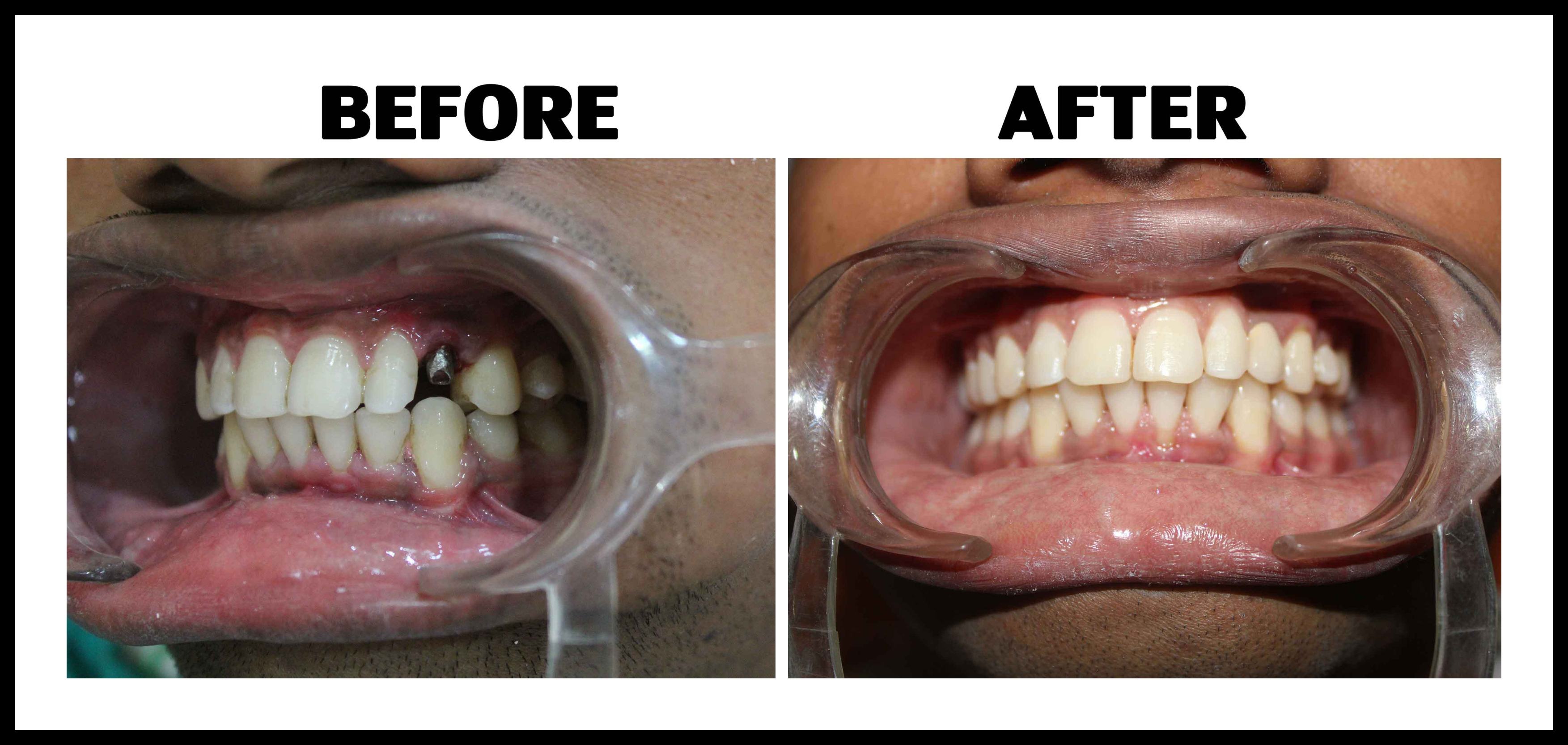 dental implant clinic in Bhubaneswar