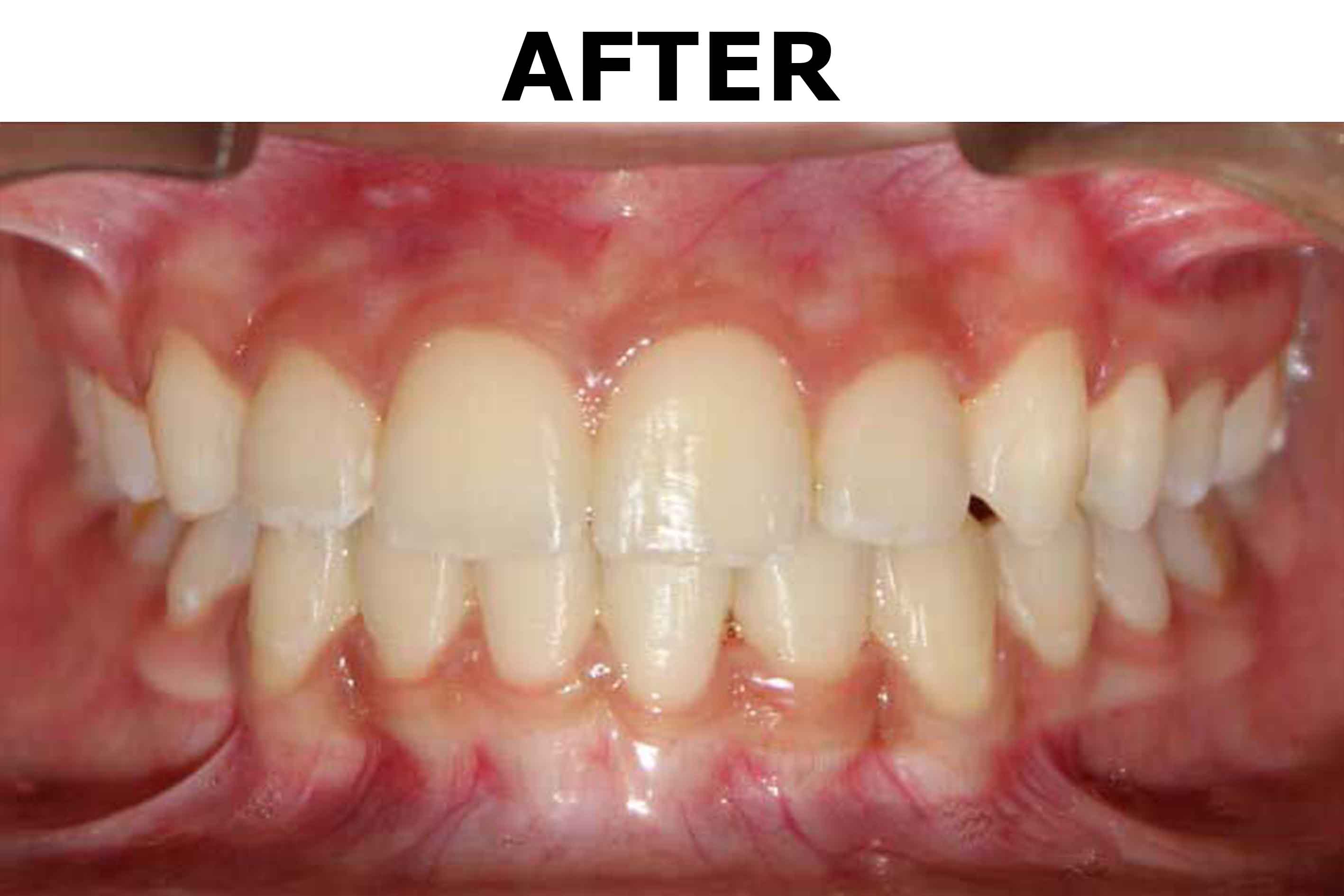 orthodontic treatment in Bhubaneswar 1