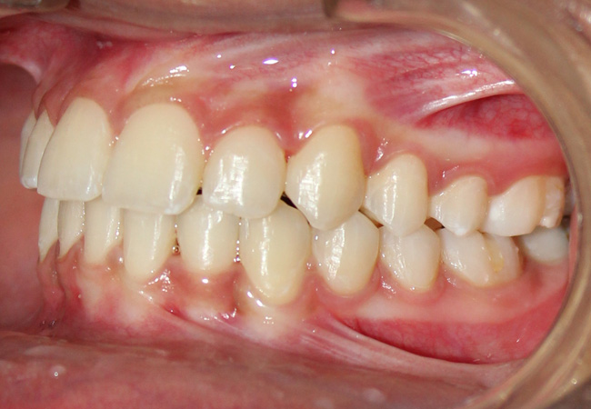 orthodontic treatment in Bhubaneswar 2