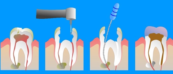 root canal treatment cost in Bhubaneswar