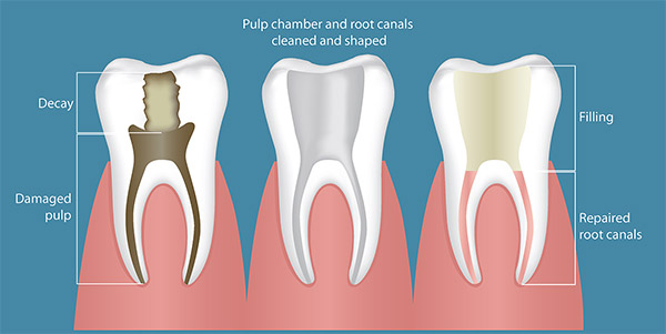 Root Canal Treatment in Bhubaneswar